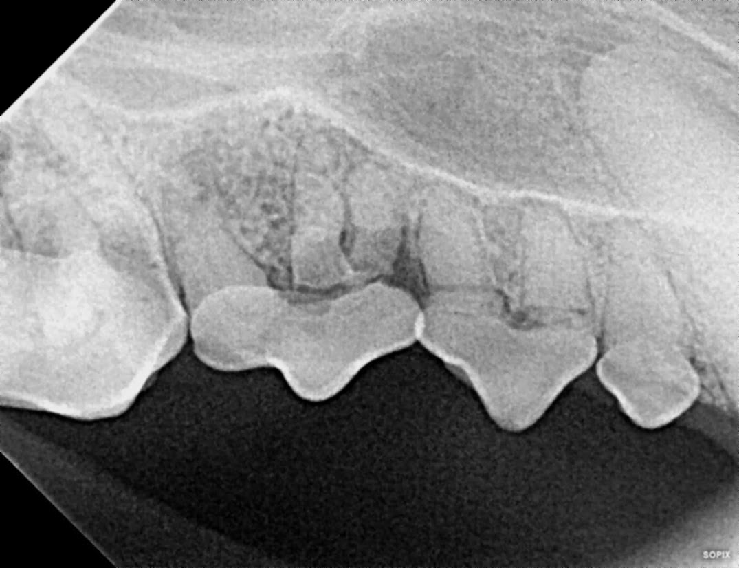 subgingival X-ray of fractured teeth