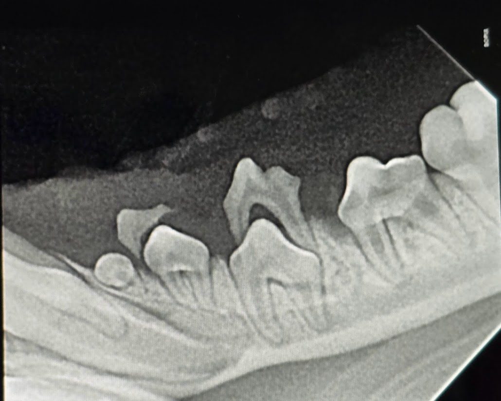 Stage 2 3 Periodontal Disease X-ray