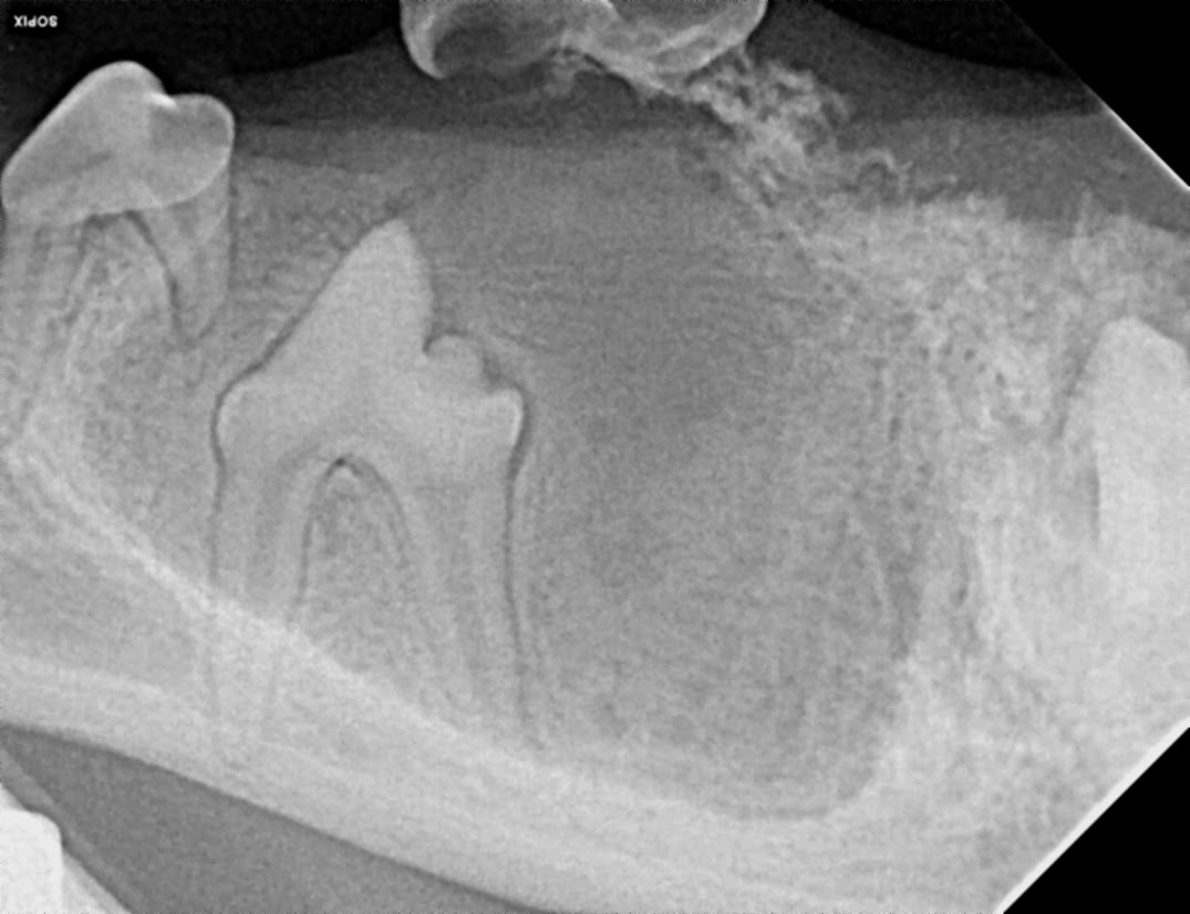 Dentigerous Cyst radiograph