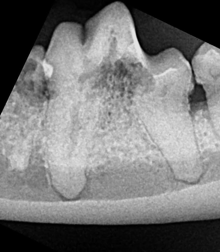 Internal Tooth Disease radiograph