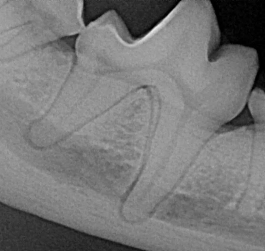 Gum Disease Normal X Ray