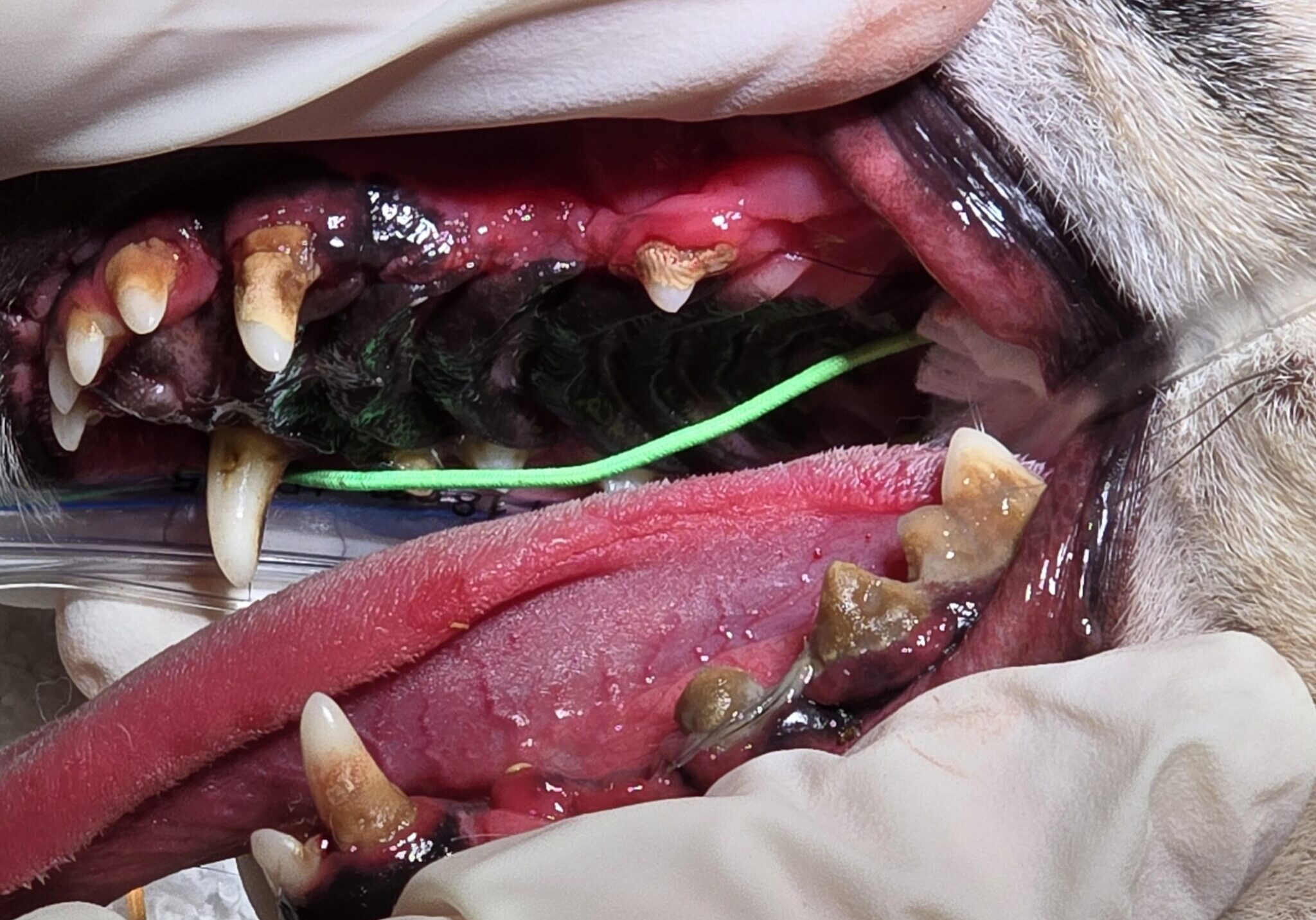 Preoperative Image Of Heavy Tartar