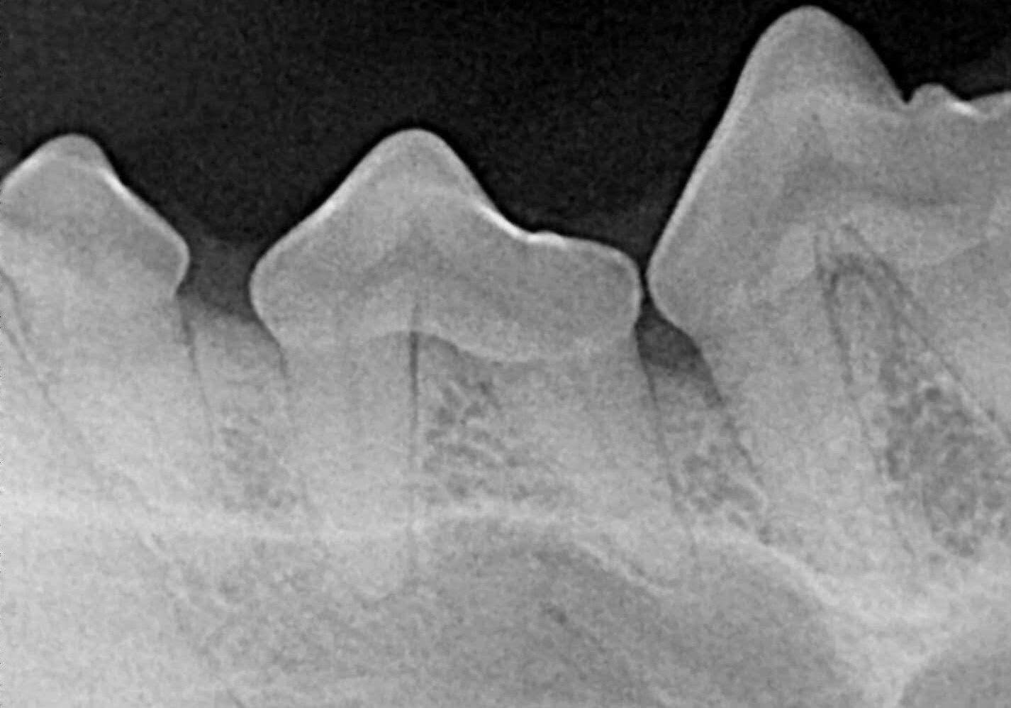 normal Lower Premolar Radiograph