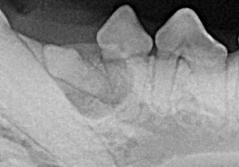 Radiograph Of Unerupted Lower Premolar Creating A Cystic Cavity