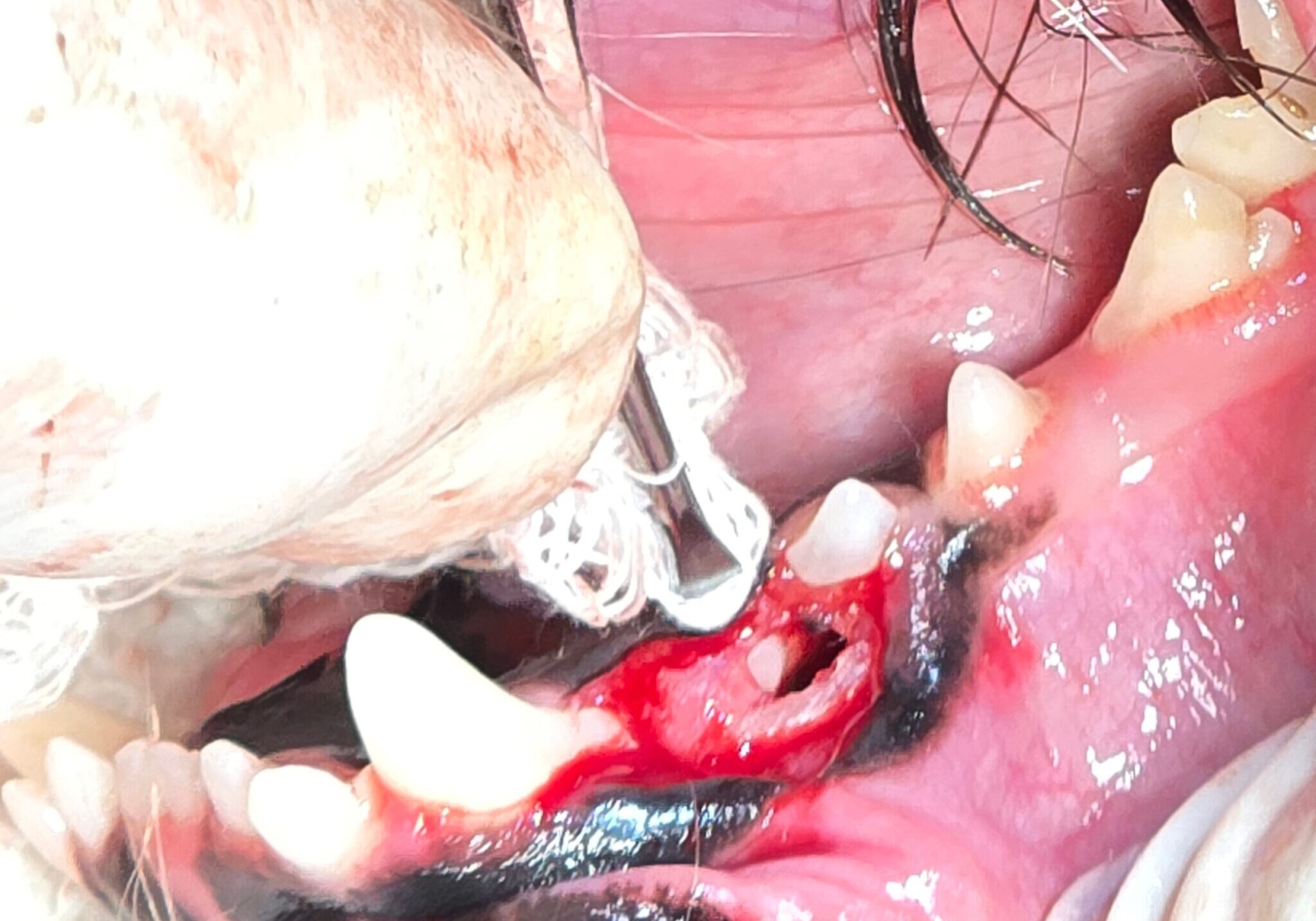 Exposed Crown Of Unerupted Tooth Lodged Between Two Teeth