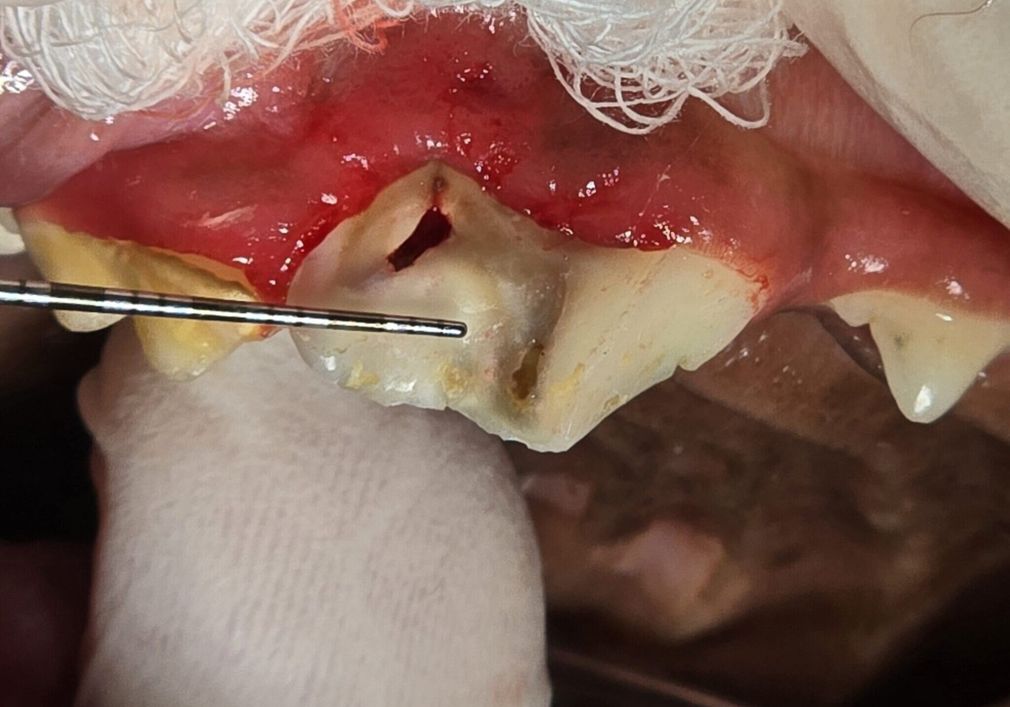 tartar Removed From Suspicious Tooth Revealing A Fractured Painful Tooth
