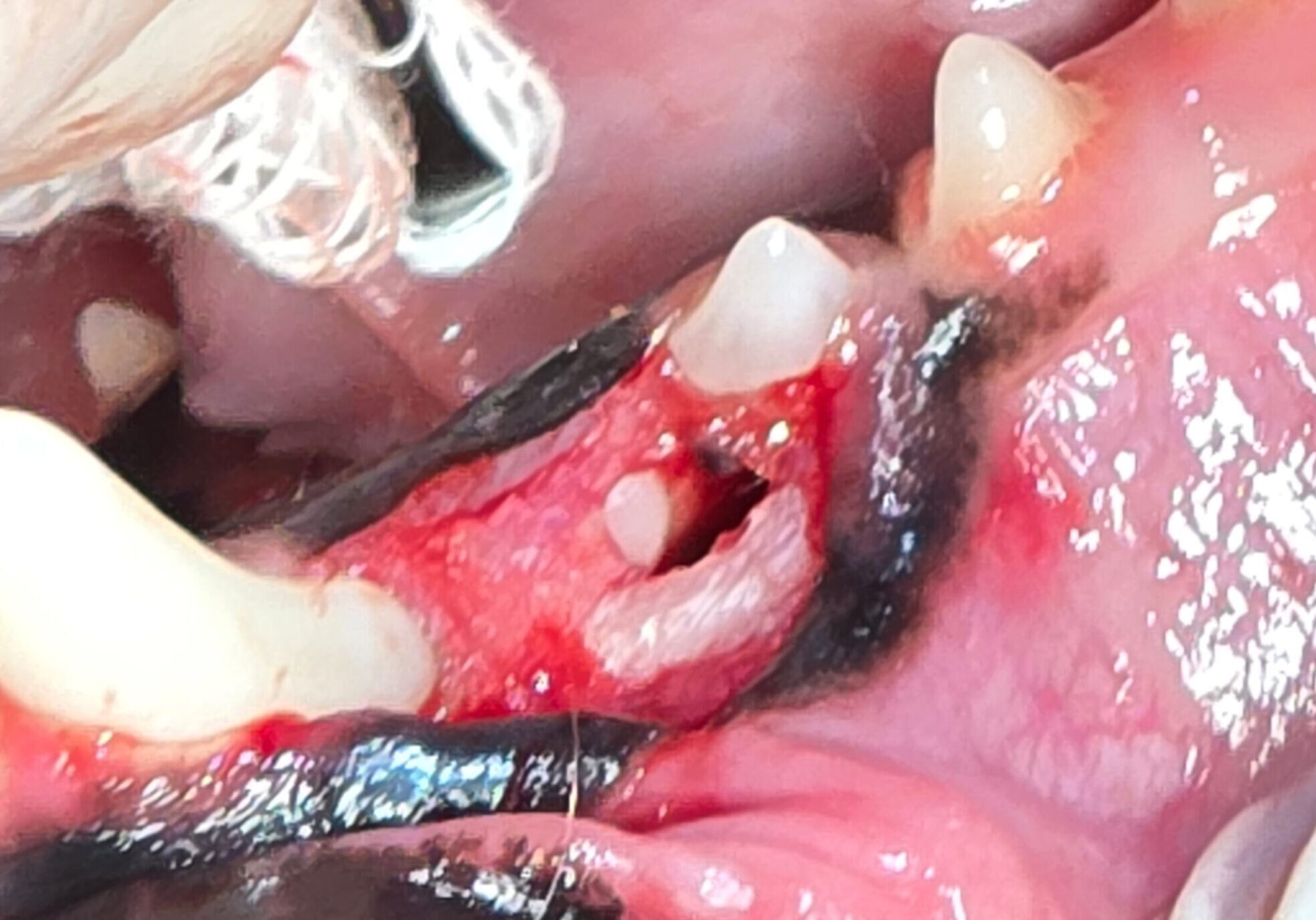 Close Up Image Of The Cystic Cavity Affeting Adjacent Teeth