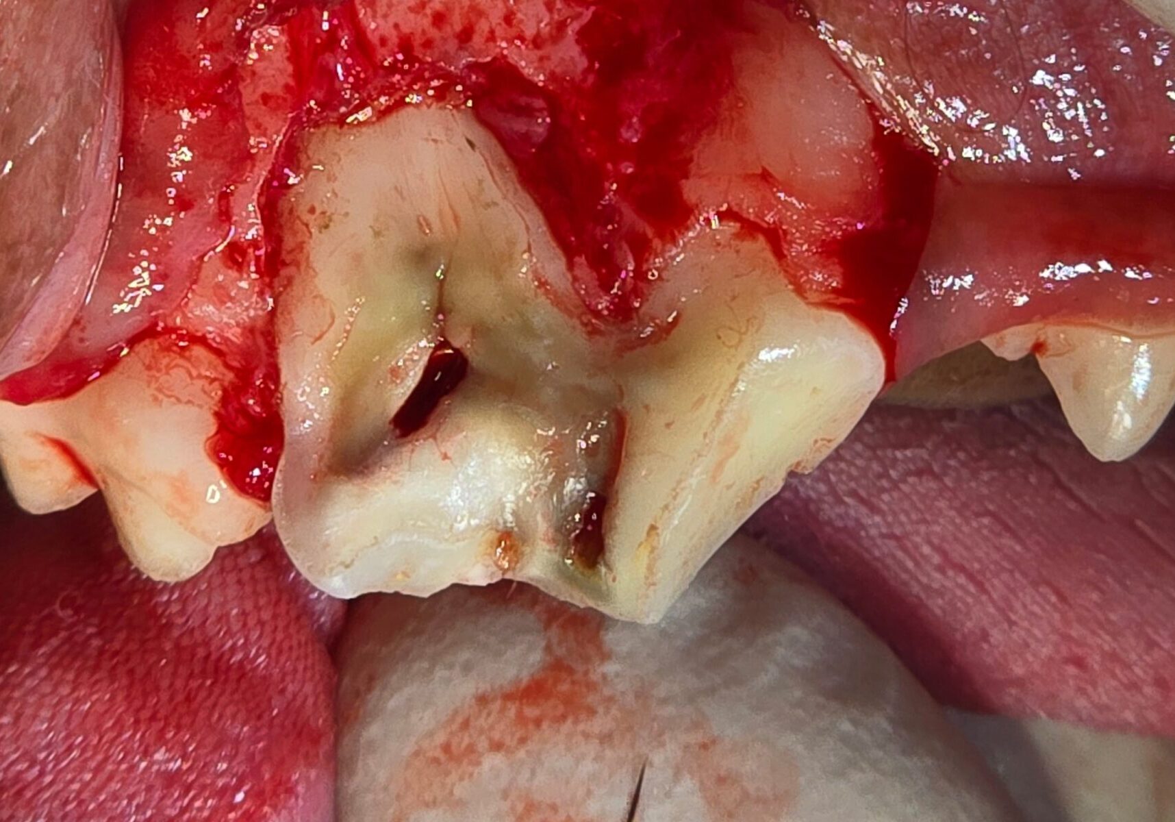 Upon Creating A Soft Tissue Flap Further Bone Destruction Noted Below The Gum Line