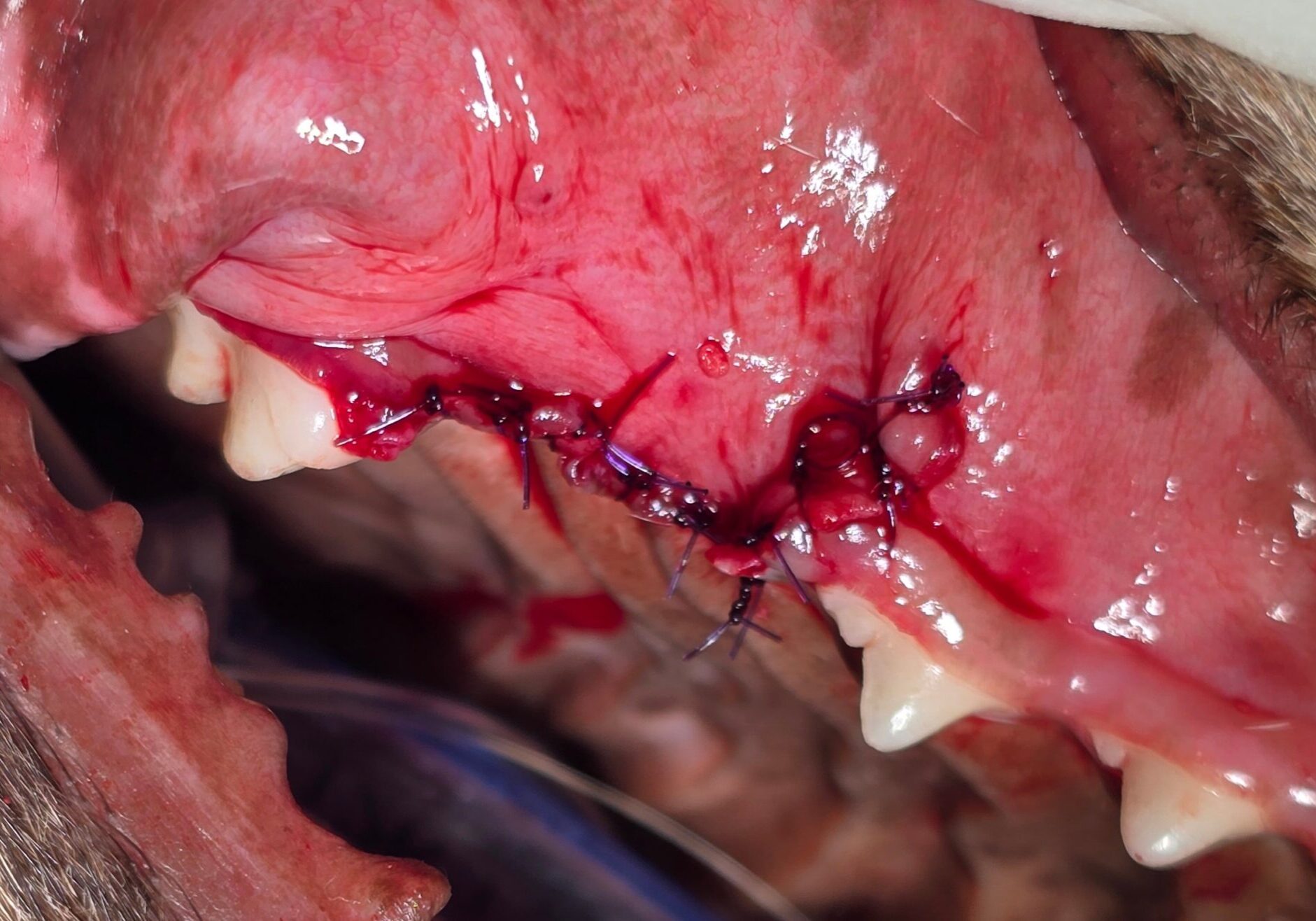 Three Rooted Tooth Removed And Sutured Close With Dissolvable Stitches