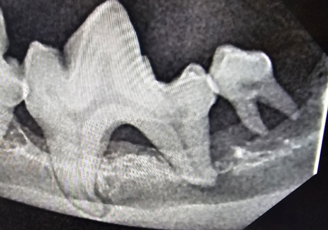 10example Of Limited Bone Supporting Tooth