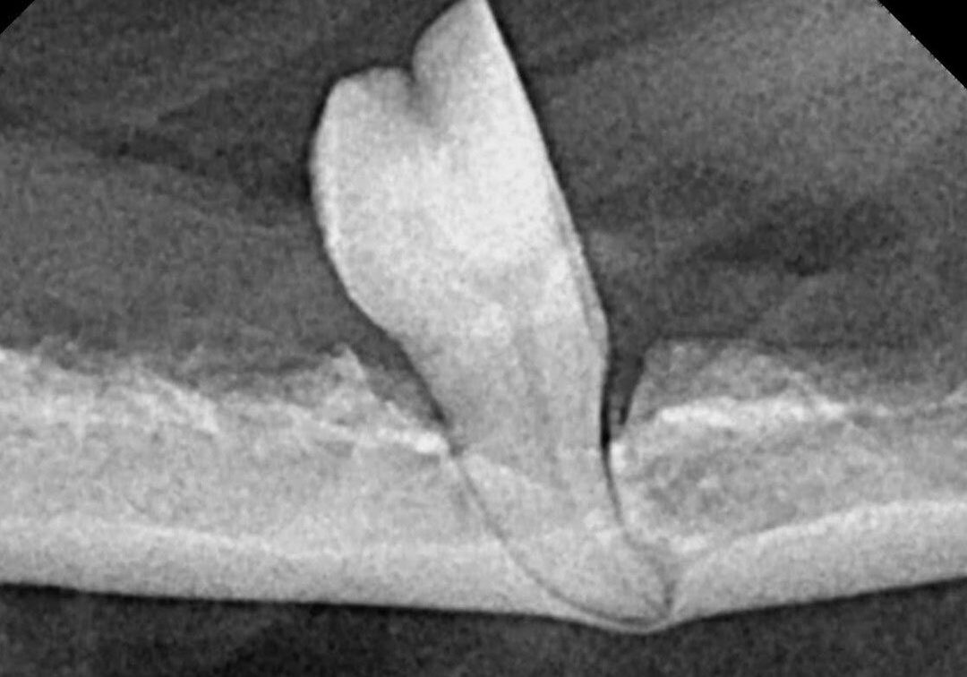 11removal Of Diseased Teeth