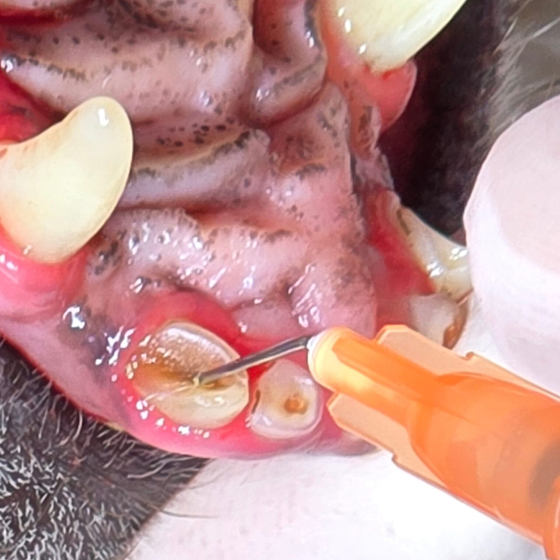 Upon Exploring 1 Out Of 6 Upper Had Pulp Exposure And Pain Requring Extraction