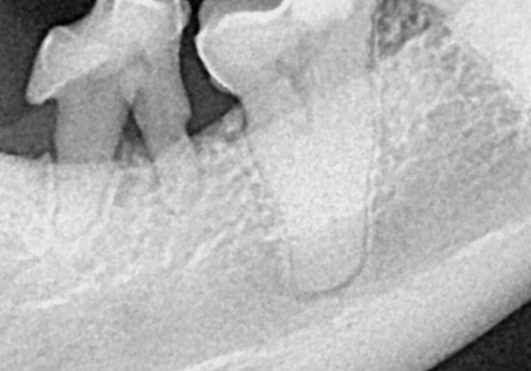3 Moderate Bone Loss