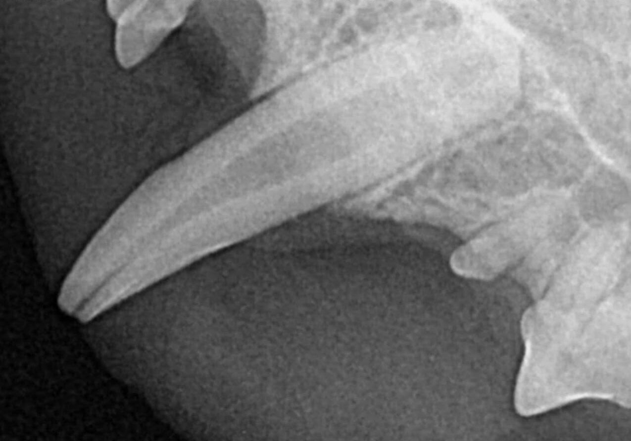 Radiograph Of The Tooth Revealing Exposed Pulp Chamber And Secondary Changes