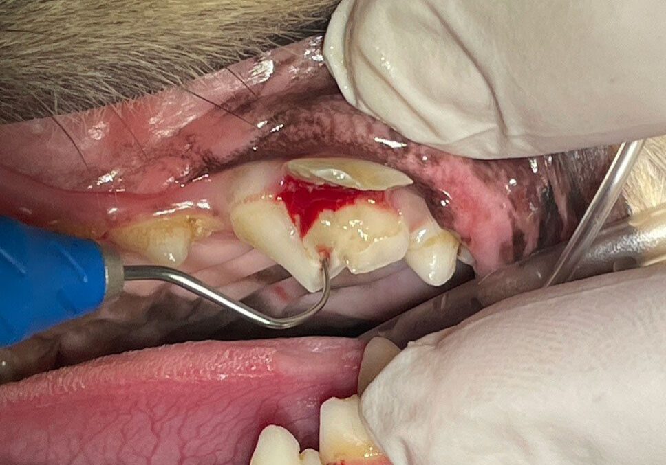 3.2.2 Surgically Explored Crown Exposing Pupl Chamber