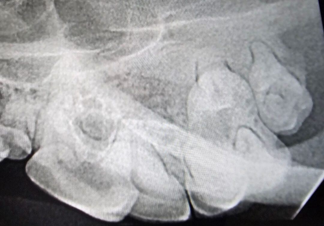 3.2.3 Normal Radiograph Of Upper Premolar And Mnolars