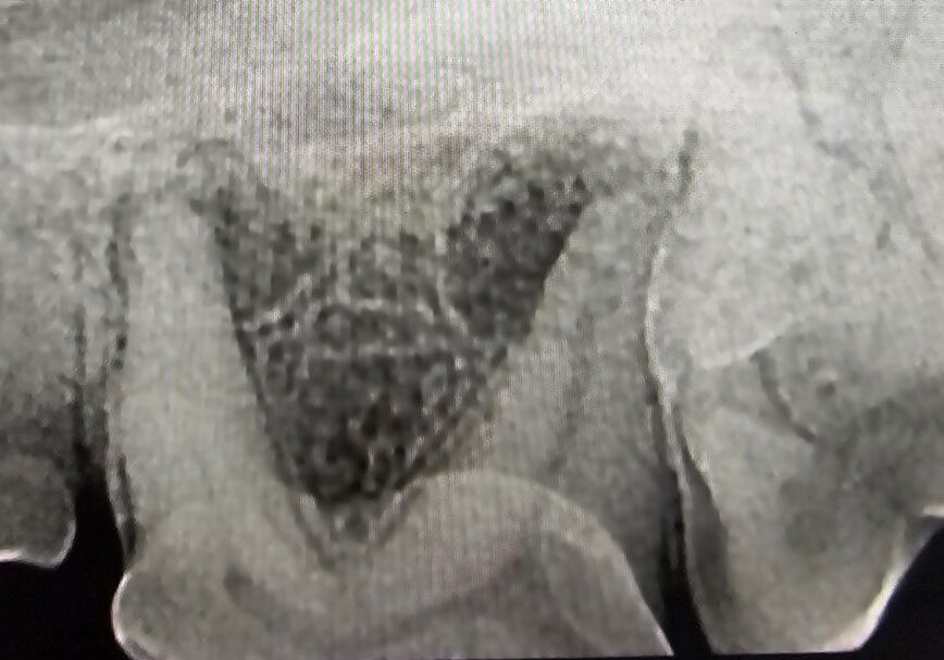 3.2.4.radiograph Of Damagedtooth Revealing Desctruction Of Bone At Multiple Rooths