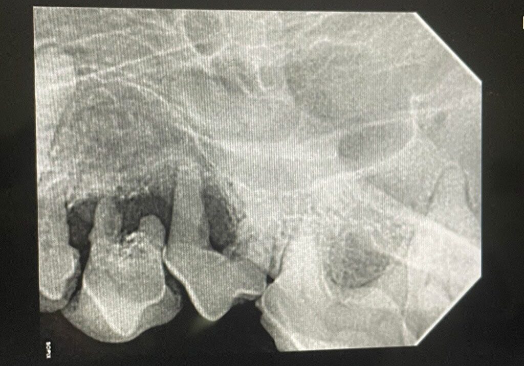 3.3.3. Radiograph Of Diseased Teeth Demonstrating Bone And Nerve Exposure