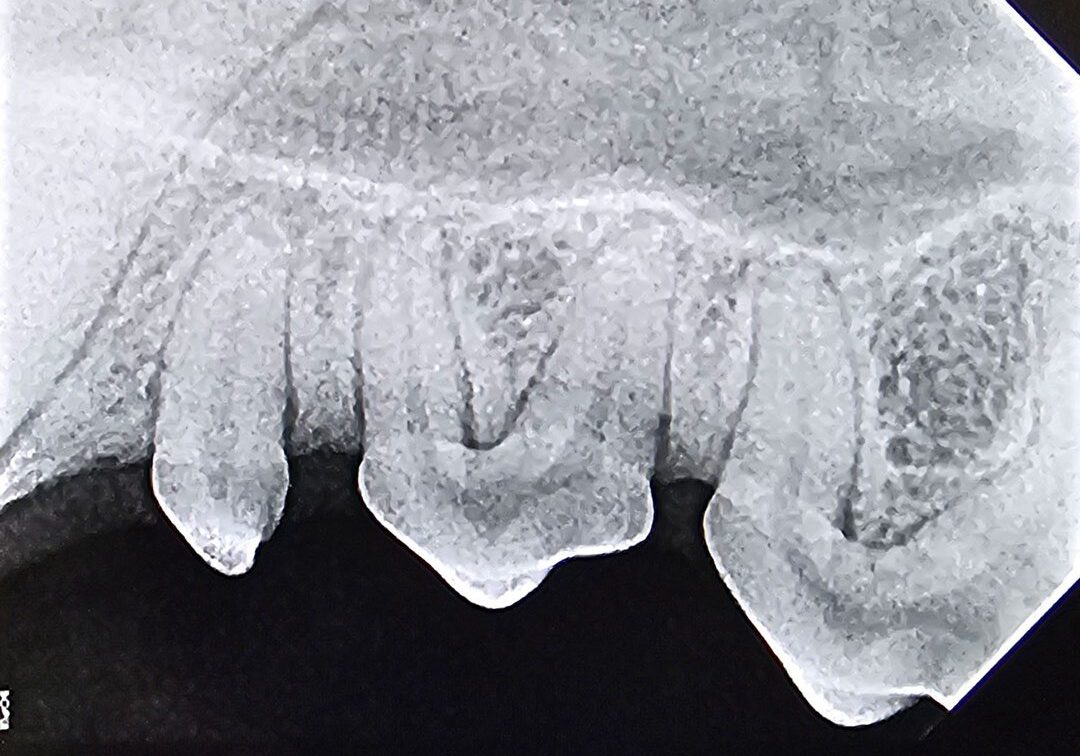 3normal X Ray Of Comfortable Premolars