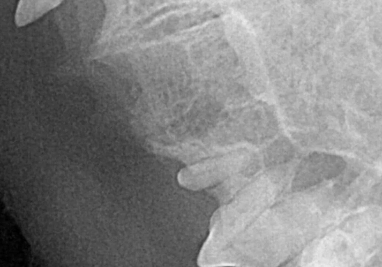 Post Surgical Extraction Of Tooth Ensuring No Root Remains