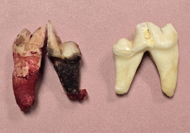 Surgically Extdracted Tooth Discolored Crown