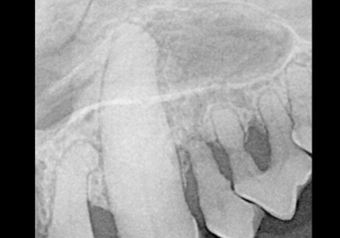 4radiograph Revealing Sever Bone Loss