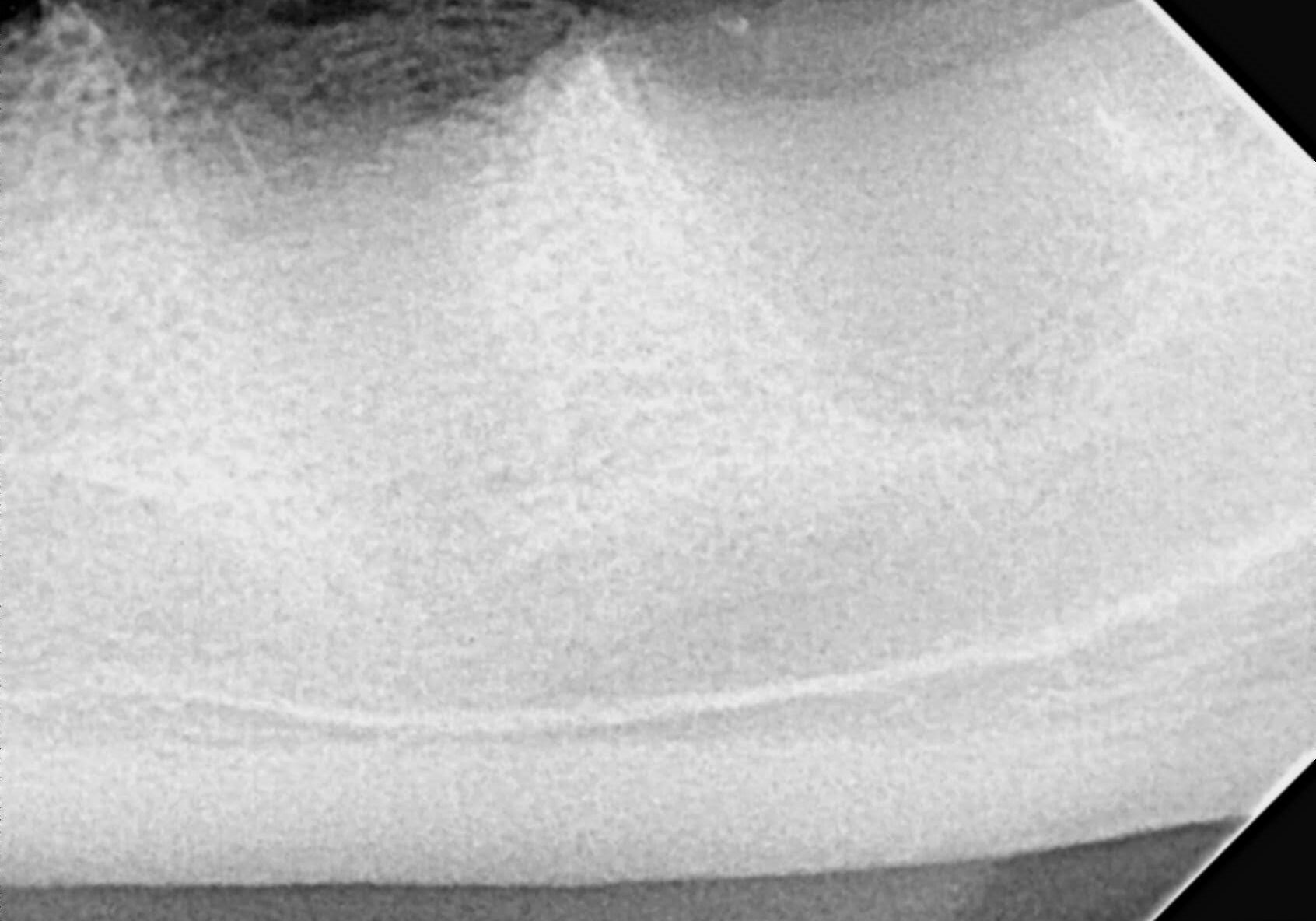 Post Exdtraction Radiograph To Ensure Root Entirely Removed And No Jaw Bone Damage Incurred