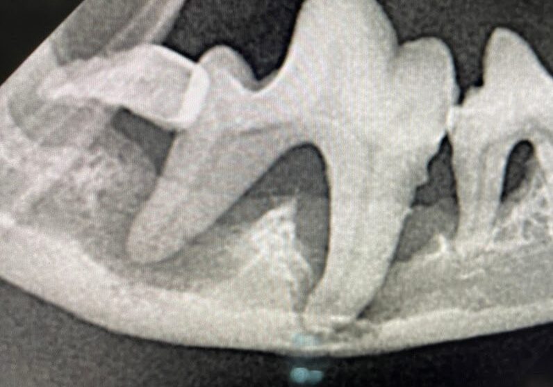 6progressive Bone Loss With Minimal Cortical Bone