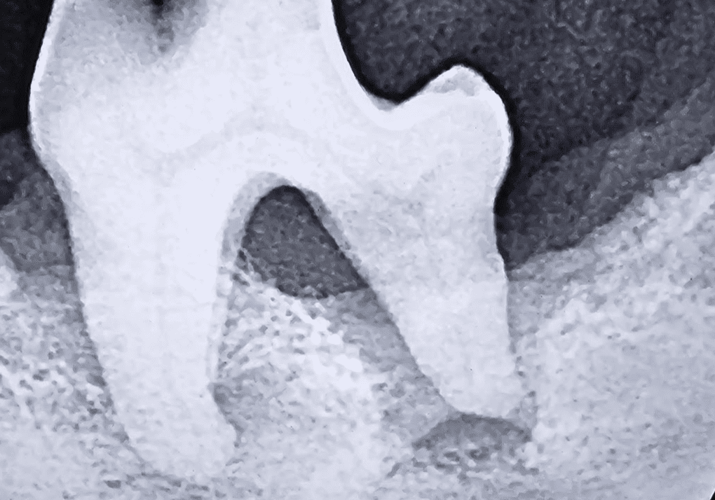 7severe Vertical Bone Loss With Weakening Mandibular Bone