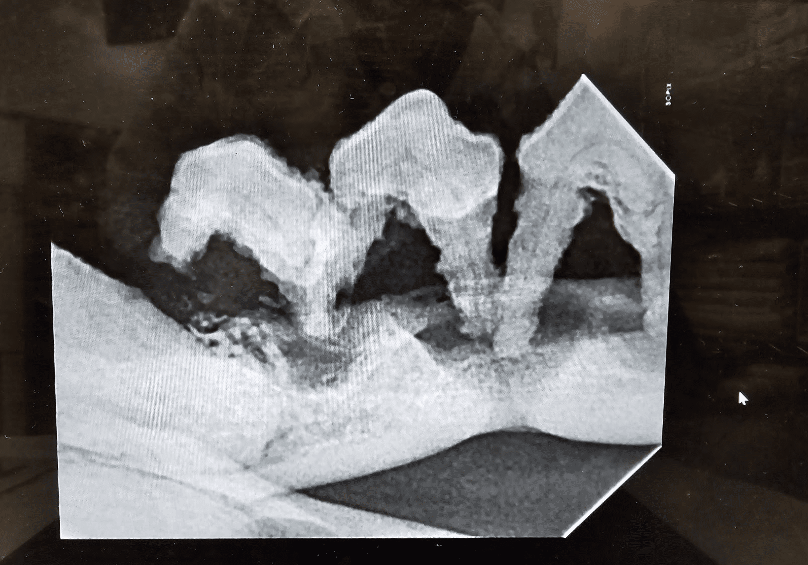 8severe Bone Loss With Advancing Bone Loss