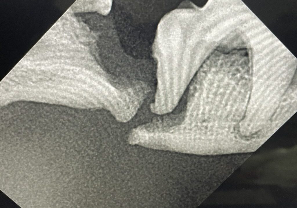 9pathalogic Fracture Of Untreated Periodontal Disease