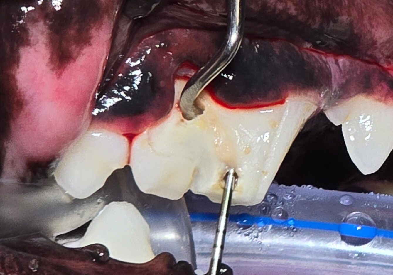 Image Of Same Tooth Once Cleaned2 Min