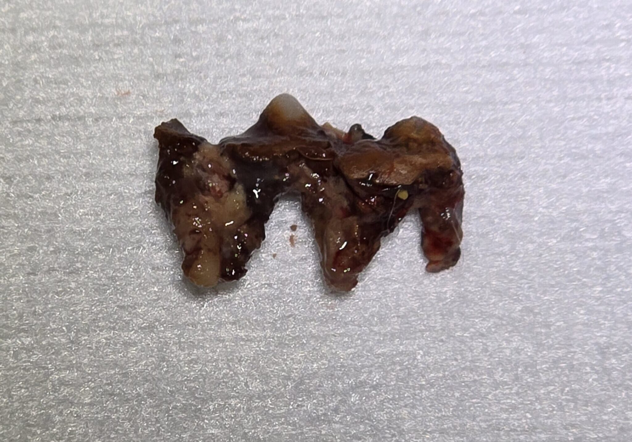 Image Of Teeth Connected Together With Bridge Of Tartar In Place Healthy Supportive Bone Min