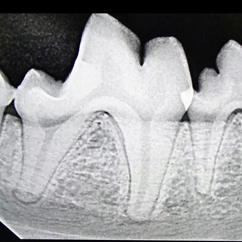 stage-one-gingivitis-x-ray