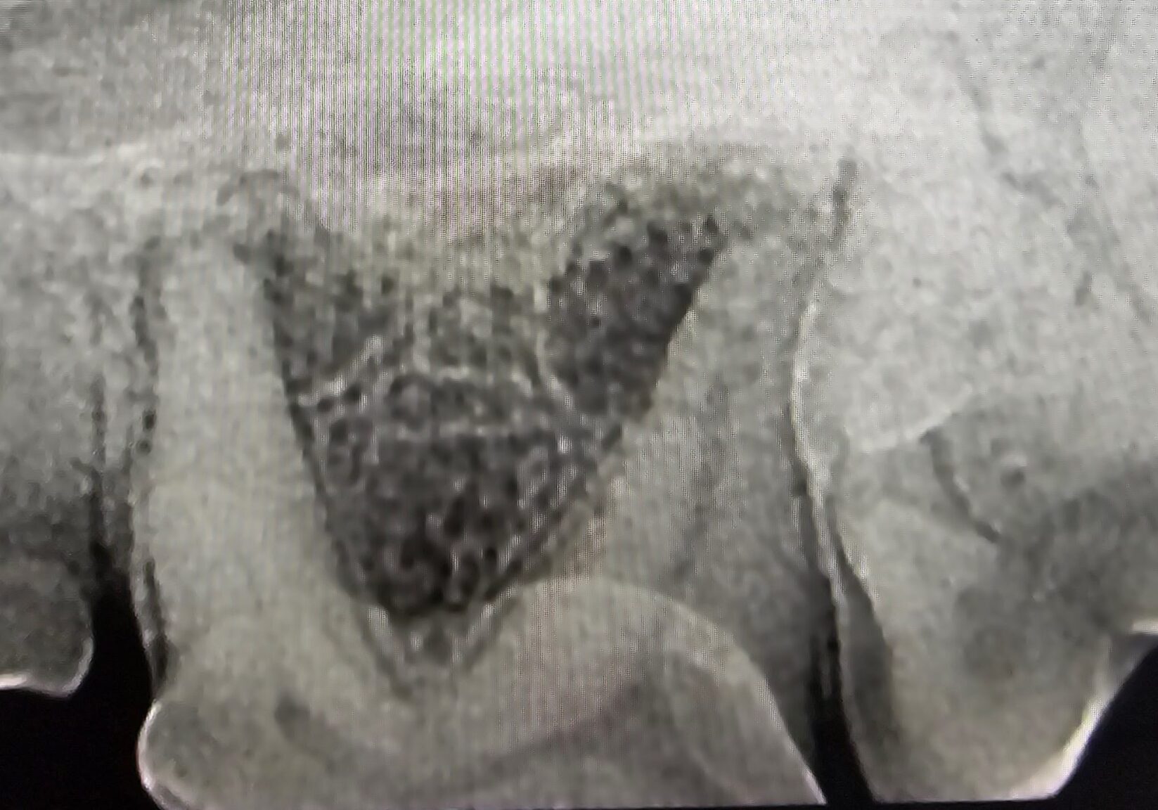 X Ray Image Of Tooth With Painful Bone Inflammation3 Min