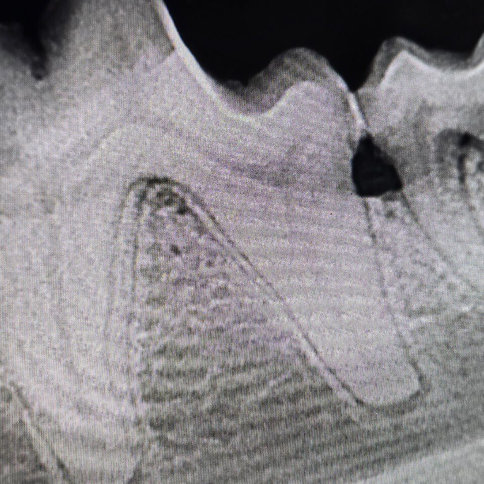 Early Periodontal Disease X Ray