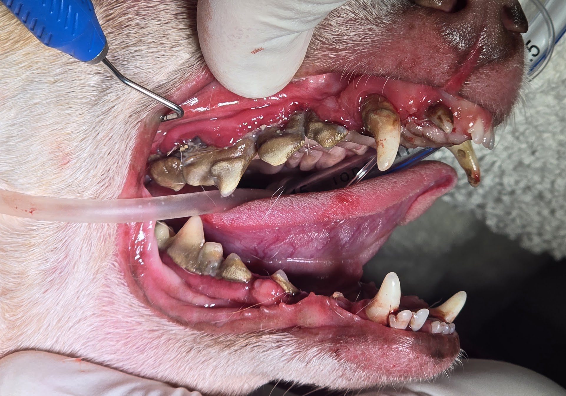 Stage Four Periodontis Disease