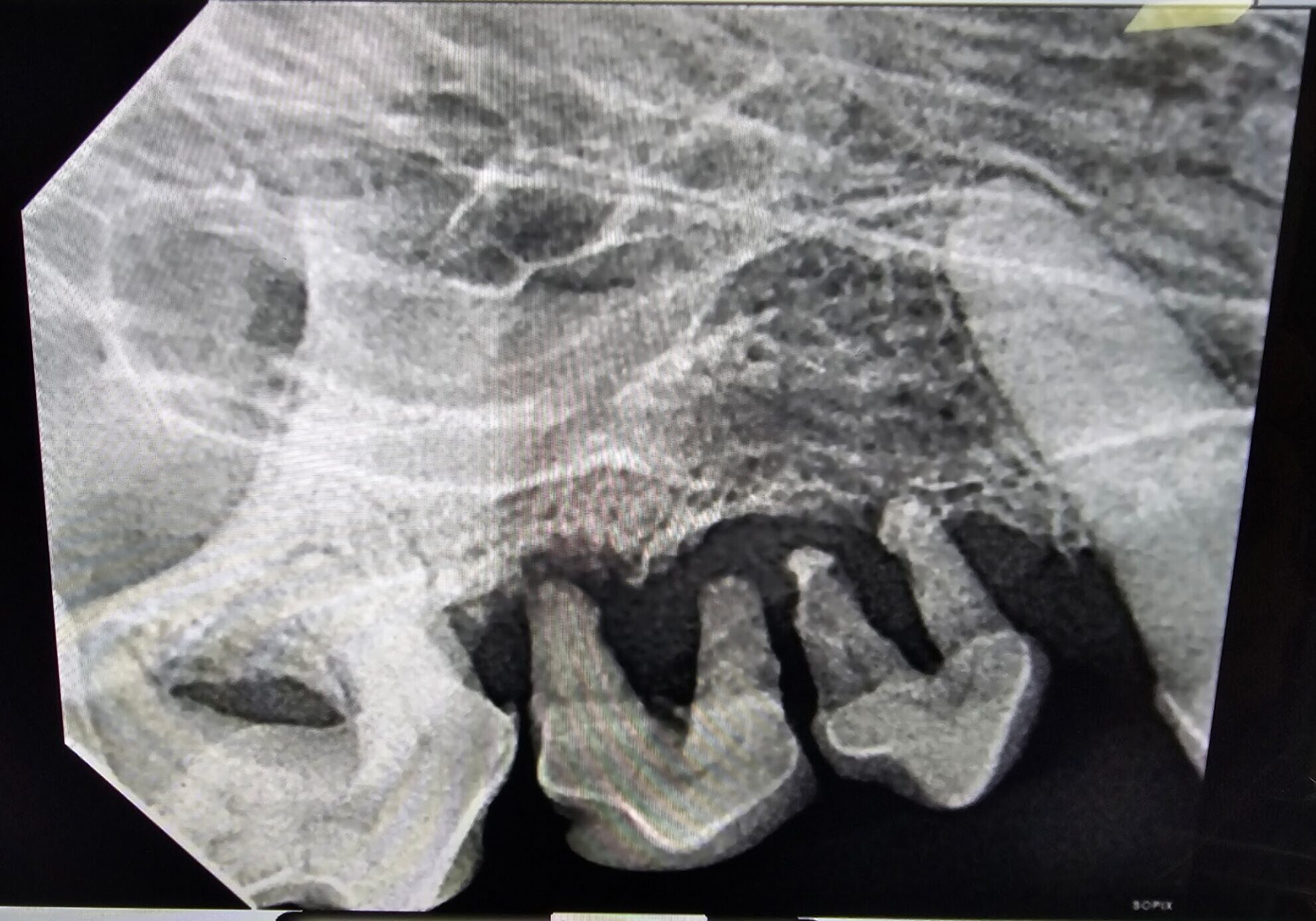 Stage Four Periodontis Disease X Ray